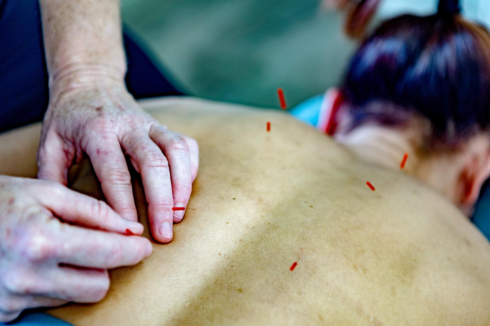 Have you thought of trying Acupuncture for stress and anxiety? 17 Acupuncture 04