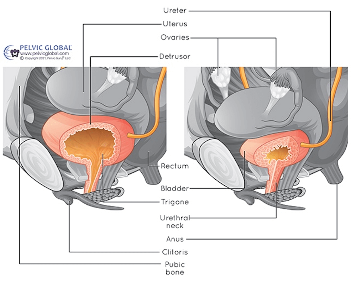 Bladder-Filling 5 Bladder Filling